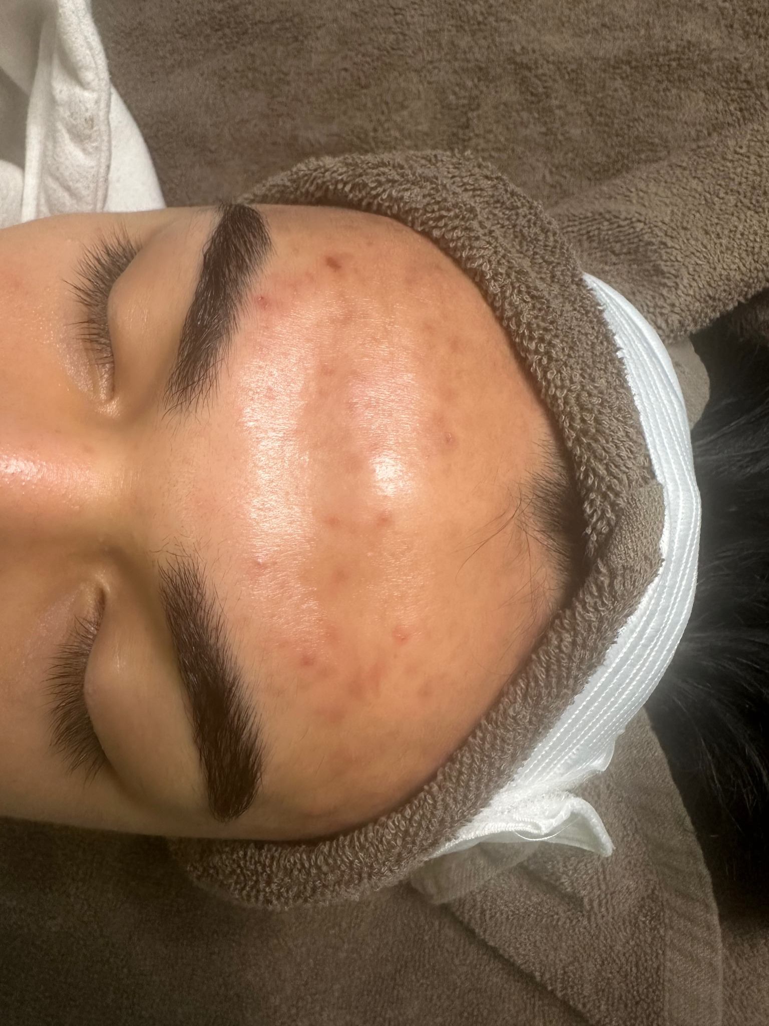 Teen acne after treatment