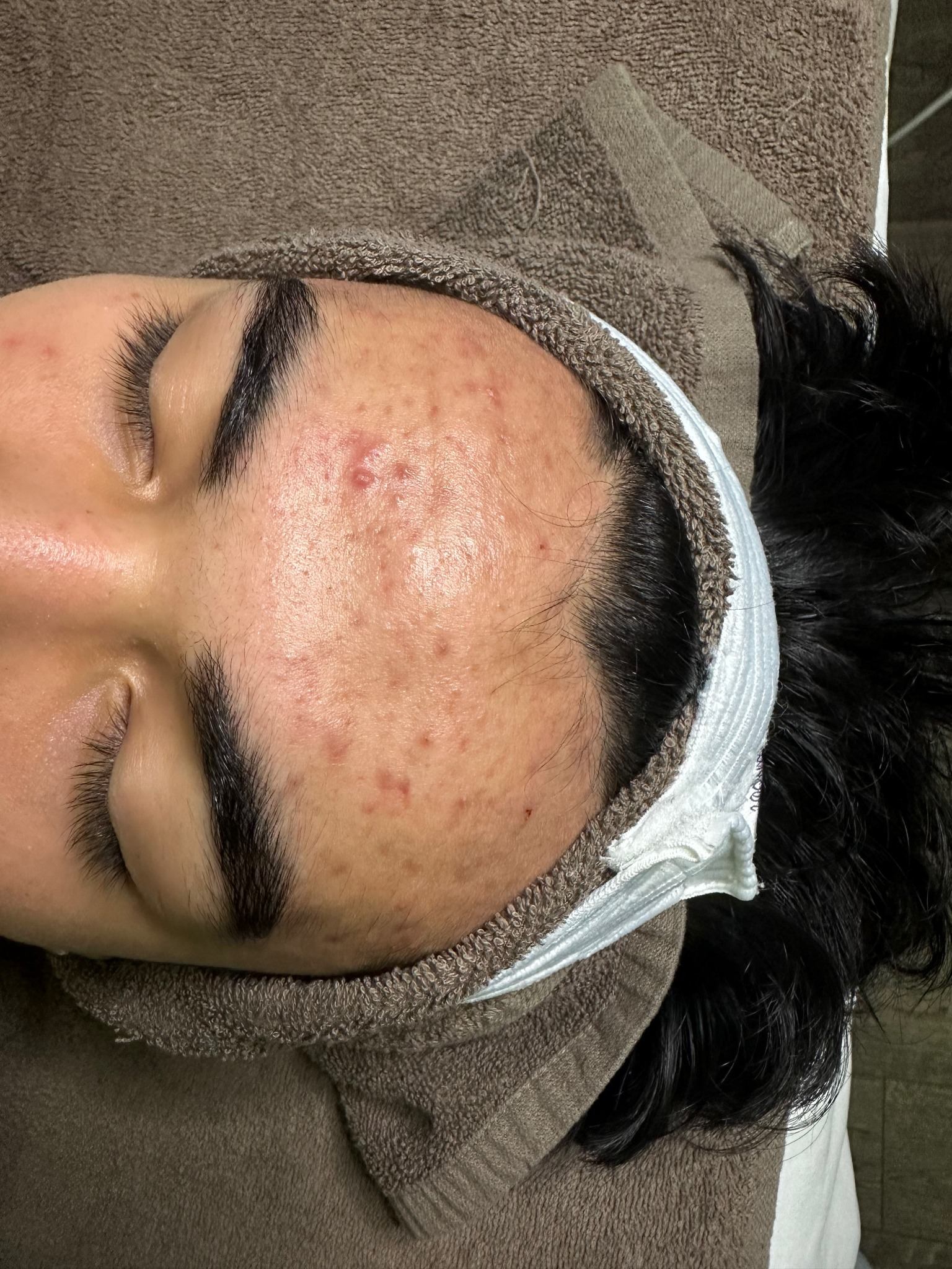 Teen acne before treatment